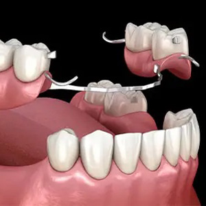 پروتز متحرک