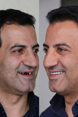 نمونه کار ایمپلنت