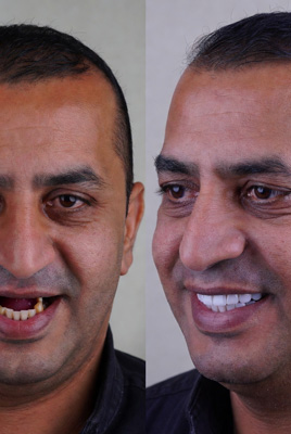 نمونه کار ایمپلنت