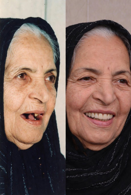 نمونه کار ایمپلنت