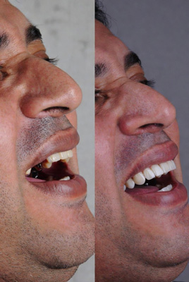 نمونه کار ایمپلنت